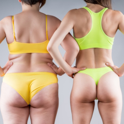 Buttocks Laser Hair Removal